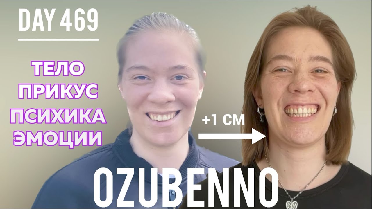 БЕЗ БРЕКЕТОВ день 469: Планас, череп, тело, психика, эмоции - связь с прикусом