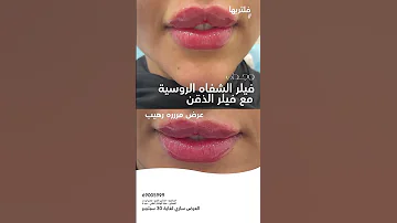 فيلر الشفاه الروسية مع فيلر الذقن 