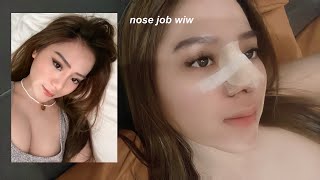 MY RHINOPLASTY JOURNEY | 1 WEEK POST-OP