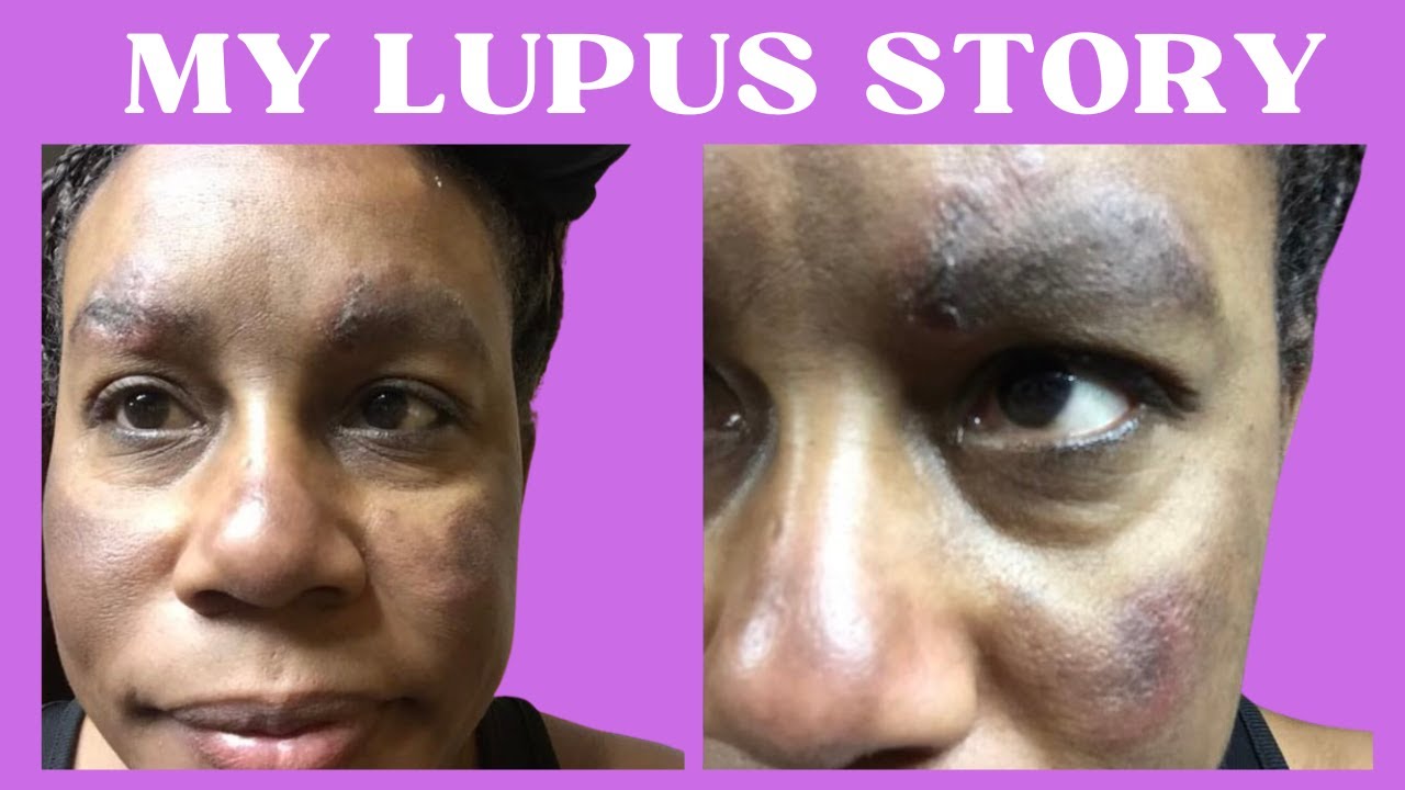 My discoid lupus story (skin condition) YouTube