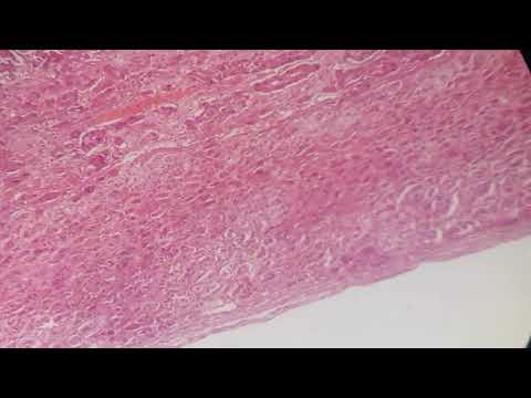 34- ورم القواتم (لب الكظر) Pheochromocytoma (Adrenal medulla)