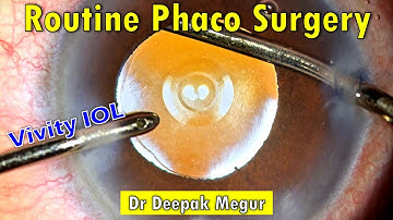 Routine Cataract Surgery with EDOF (VIVITY) Lens Implantation - Dr Deepak Megur