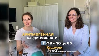 Аритмогенная кардиомиопатия. Повышение ФВ с 30 до 60. Кардиолог. Эхокардиография ДО и ПОСЛЕ лечения