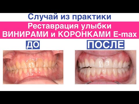 Реставрация улыбки с помощью виниров и зубными коронками из керамики E-max