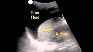 Trauma FAST Exam - LUQ Exam - Sonosite