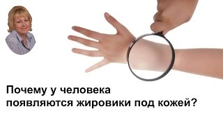 Почему у человека появляются жировики под кожей? Почему у человека появляются жировики под кожей?
