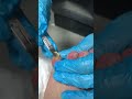 Incredibly Relaxing Long Ingrown Toenail Trimming#nails #satisfying #fish #duet