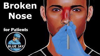 Nasal Fractures: Patient Education
