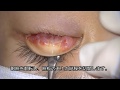 ※手術動画 皮膚を切らない眼瞼下垂手術(経結膜挙筋短縮術) posterior approach of ptosis surgery