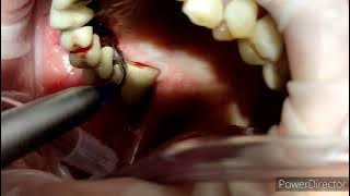 Pulizia impianti dentali: Dott. Daniele Mellace