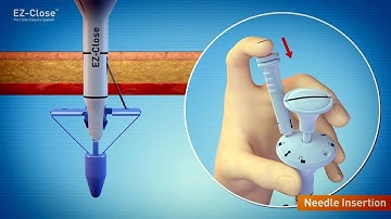 Medical Impact EZ Close  port site closure system