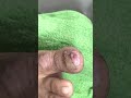 Ep_3922 Ingrown toenail removal 👣 เคสแบบนี้..ดูยากออกมาเป็นชิ้นเล็ก ๆ  😁 (clip from Thailand)