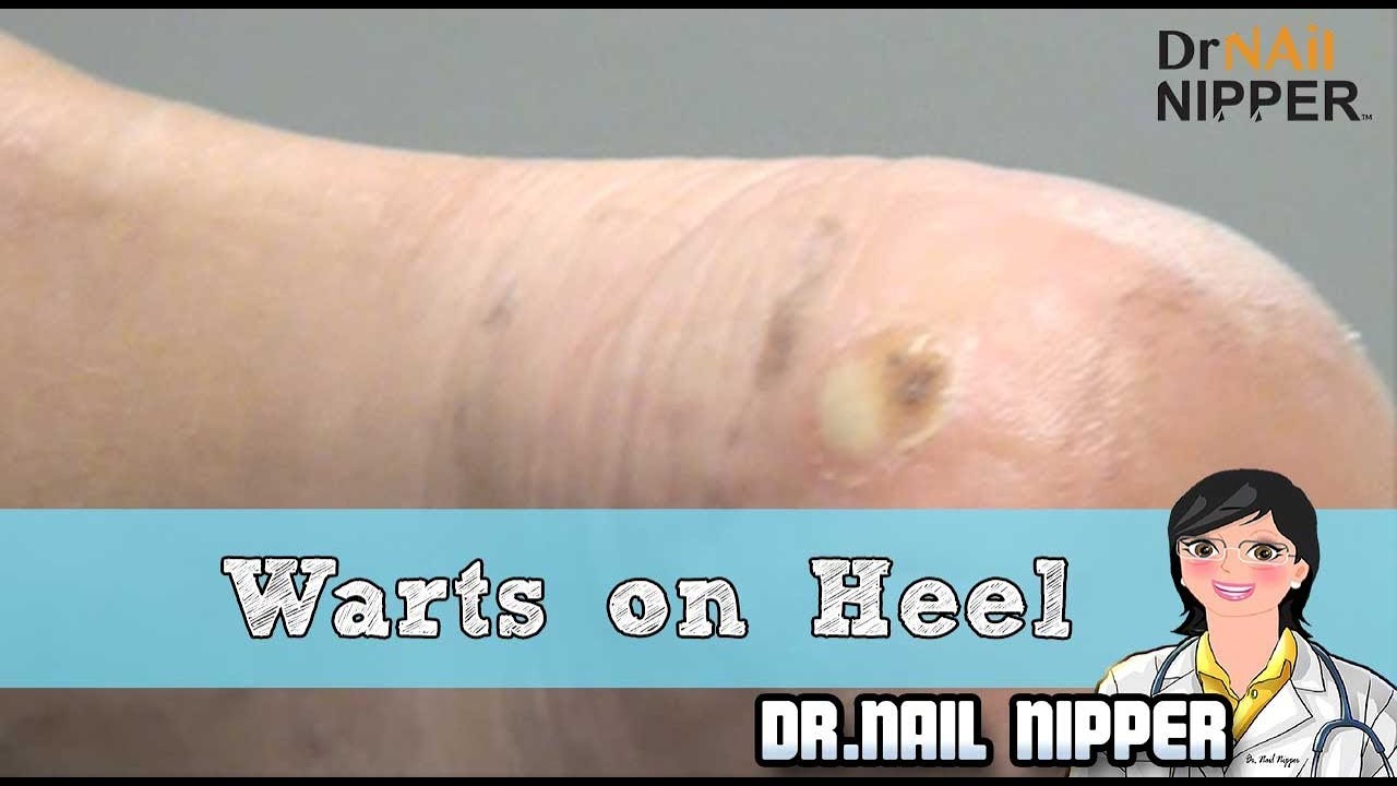 Two Patients with Warts on Heel, Foot Warts YouTube