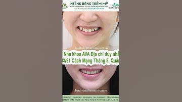 Niềng răng chen chúc, khấp khểnh trước và sau #niengrang #niengrangmom  #niềngrăngtrongsuốt