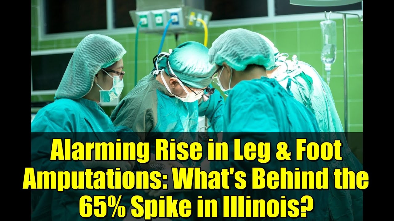 Alarming Rise in Leg & Foot Amputations: What's Behind the 65% Spike in Illinois?