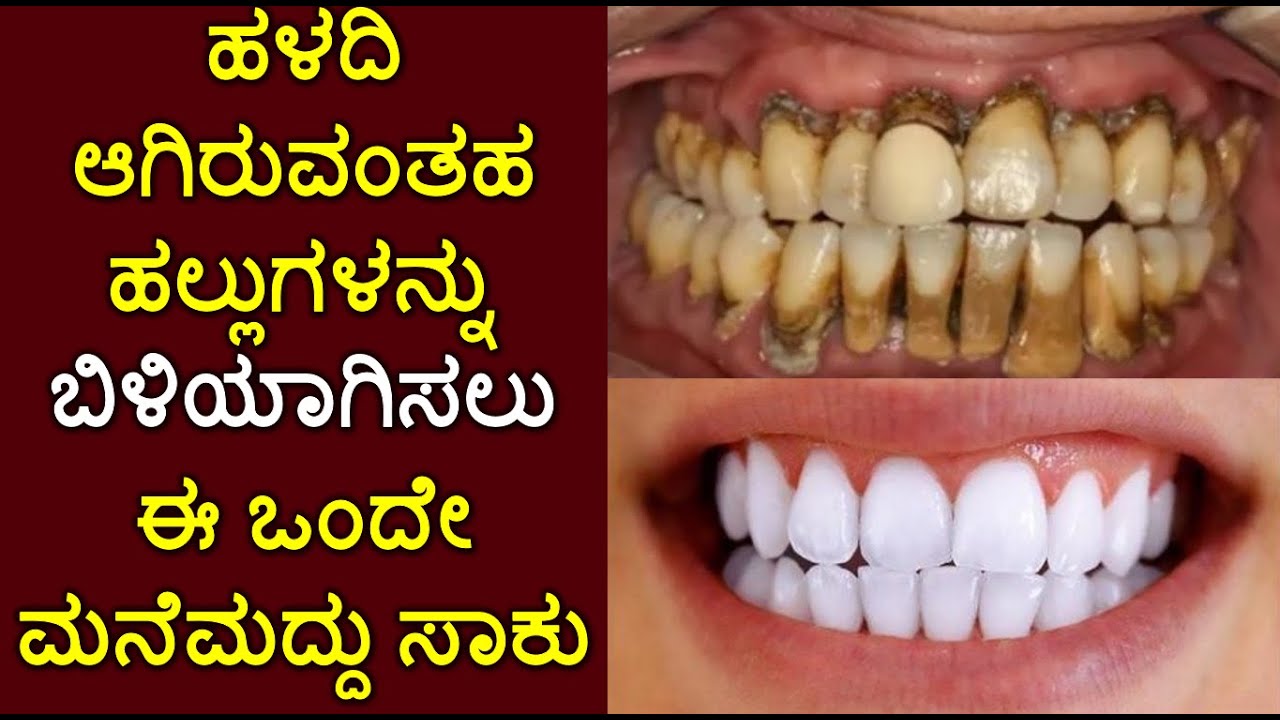 teeth whitening tips in kannada Home Remedies For Teeth Whitening at