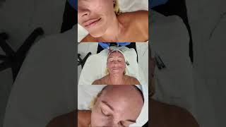 Microneedling With Topical Toxin for Smoother Skin and Refined Pores