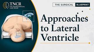 Approaches to the Lateral Ventricle | Transcortical vs Transcallosal vs Endoscopic Corridors