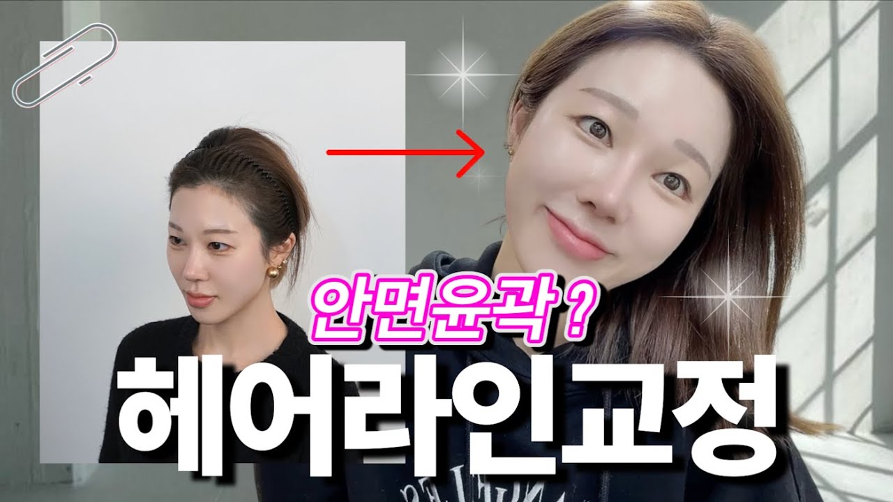 헤어라인 문신vs모발 이식 어느 쪽이 더 나을까? 