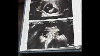 Francisco and Natalie Romero talk about their experience coming to terms with having conjoined twins