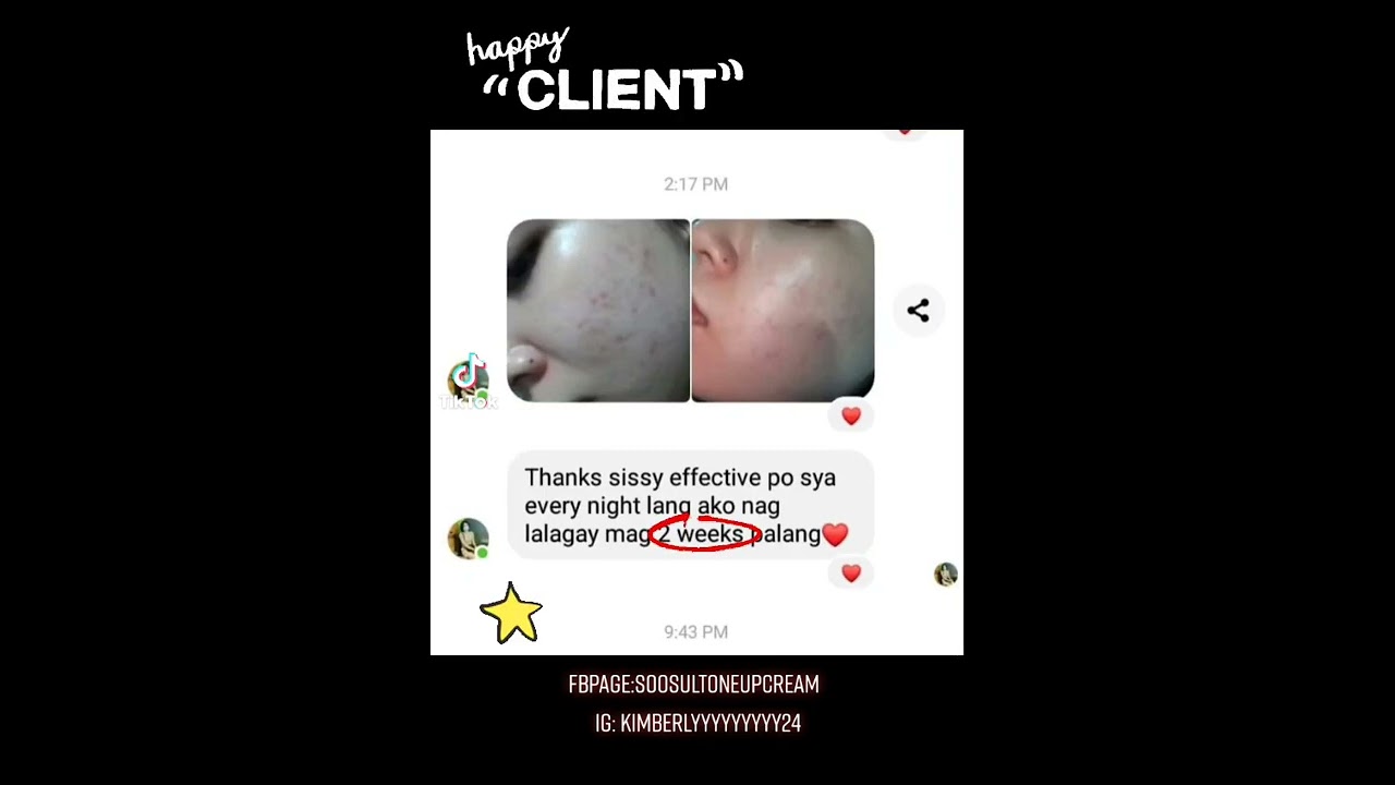 Goodbye dark pimple marks na talaga 👋💯 