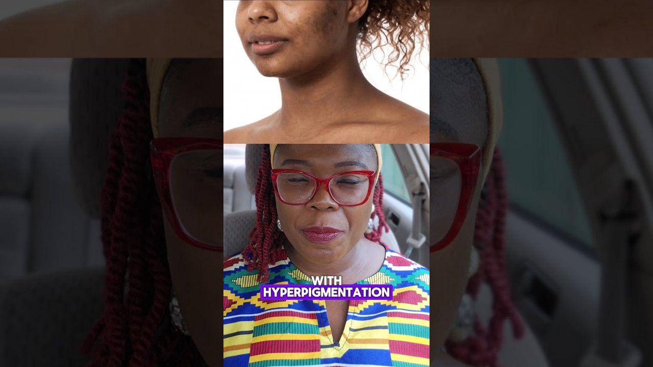 Day 16- sunscreen for hyperpigmentation.