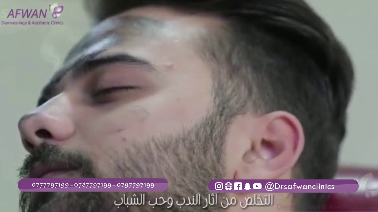 التقشير الكربون 5  dr safwan aladwan dermatology and aesthetic clinics