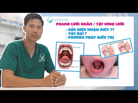 Video Tật dính lưỡi, ngắn lưỡi, nói ngọng là gì? Phanh lưỡi... - youtube
