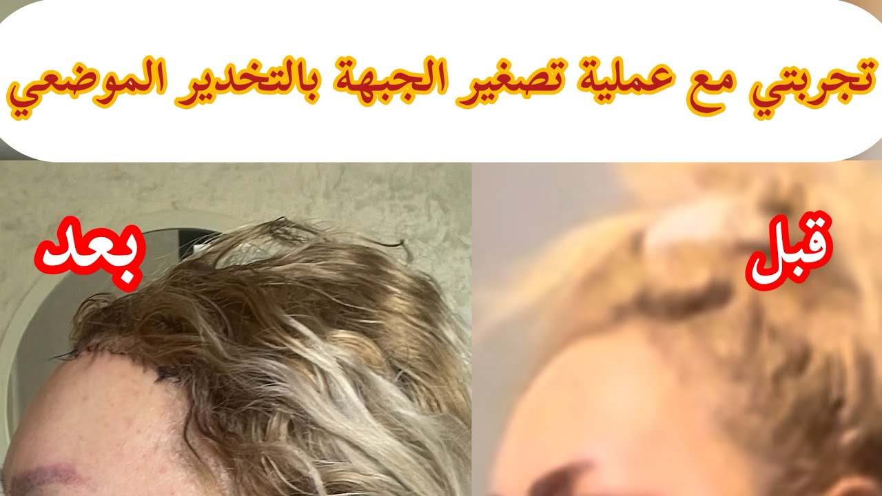تجربتي مع عملية تصغير الجبهة بالتخدير الموضعي في اقل من ساعتين (النتيجة اخر الفيديو)