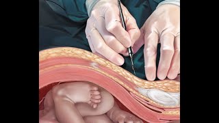 Cesarean section PT Dr. Mohamed Gamal screenshot 5