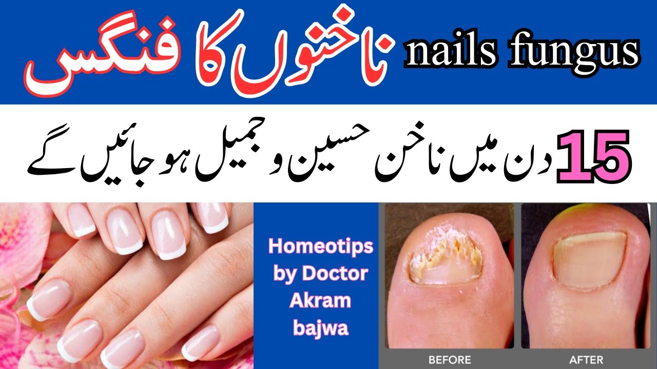 Nakhun me Fungus Infection ka ilaj Nails Fungus Easy Treatment