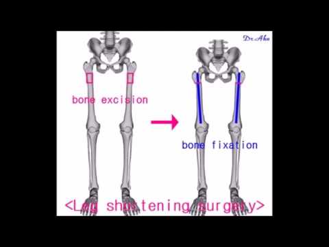 The principle of shortening the height (leg shortening surgery)