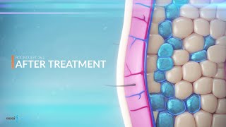 3D Medical Product Animation For Coolsculpting Fat Freezing Technology