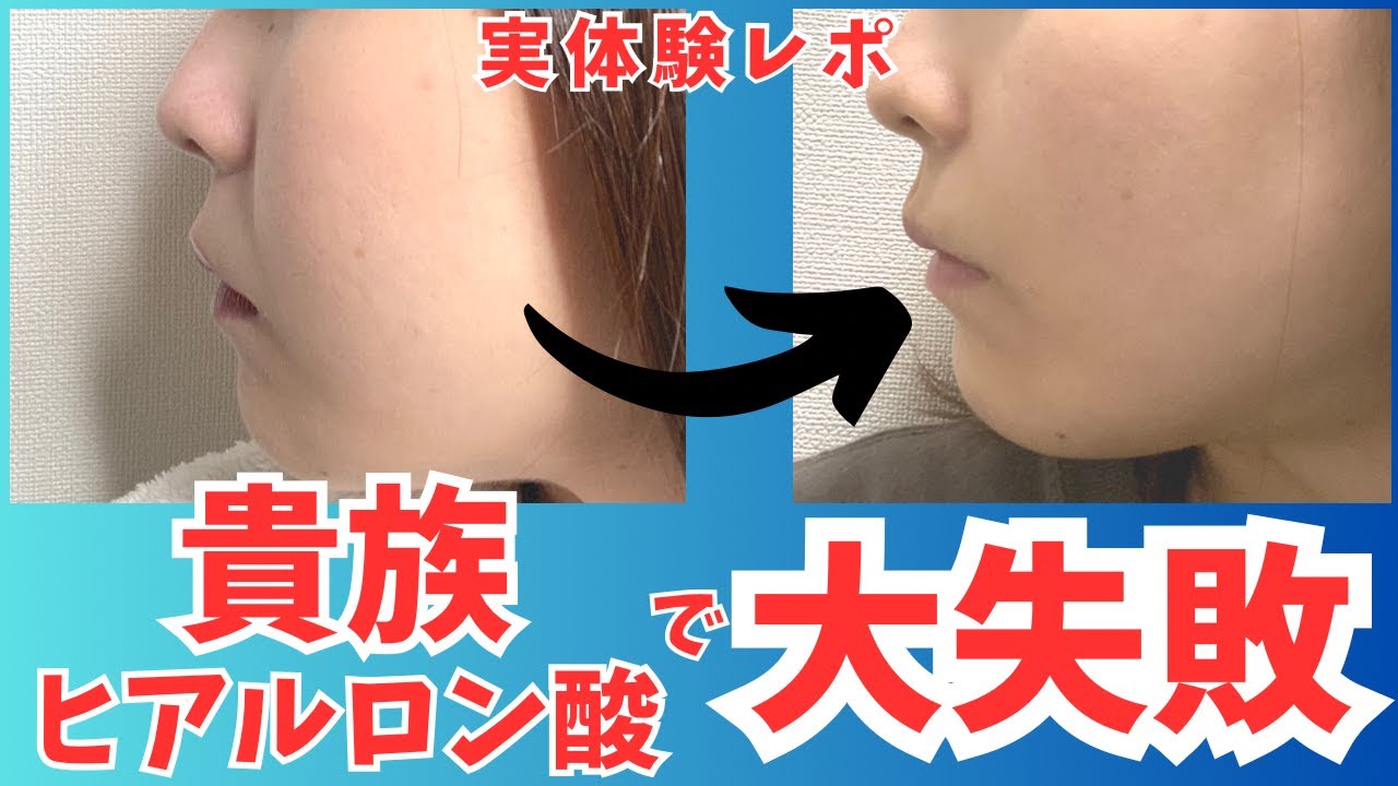 【貴族フィラー】整形初心者がヒアルロン酸をなめていたら割と大失敗したレポ【鼻翼基部／ほうれい線／プチ整形】