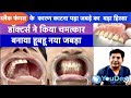 rehabilitation of maxilla | dental implants|best dental implant centre in india|YouDent Hospital |