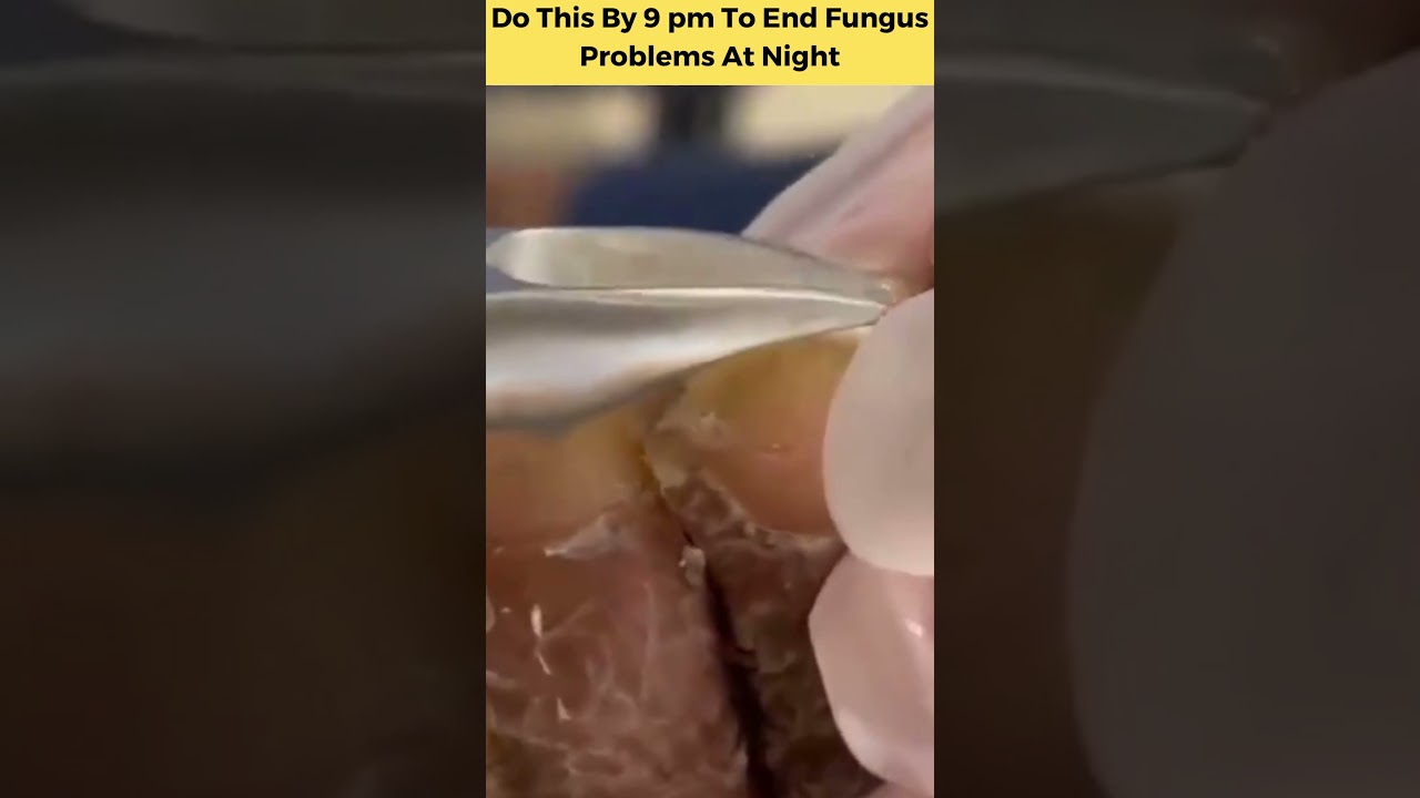 Do This By 9pm To End Fungus Problems At Night| Metanail Complex Review| #metanailreview #shorts