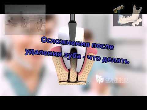 Какие осложнения могут возникнуть после удаления зуба?
