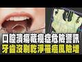 口腔潰瘍反覆發作恐藏癌症危險警訊! 反覆嘴破並非火氣大 嘴巴細菌太多恐致癌...口腔細菌藏胰臟癌驚人關聯 牙齒沒刷乾淨罹癌風險增3倍｜【話題懶人包】｜TVBS新聞 @TVBSNEWS01