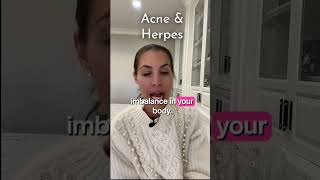 Are You More Prone to Acne if You Have Herpes