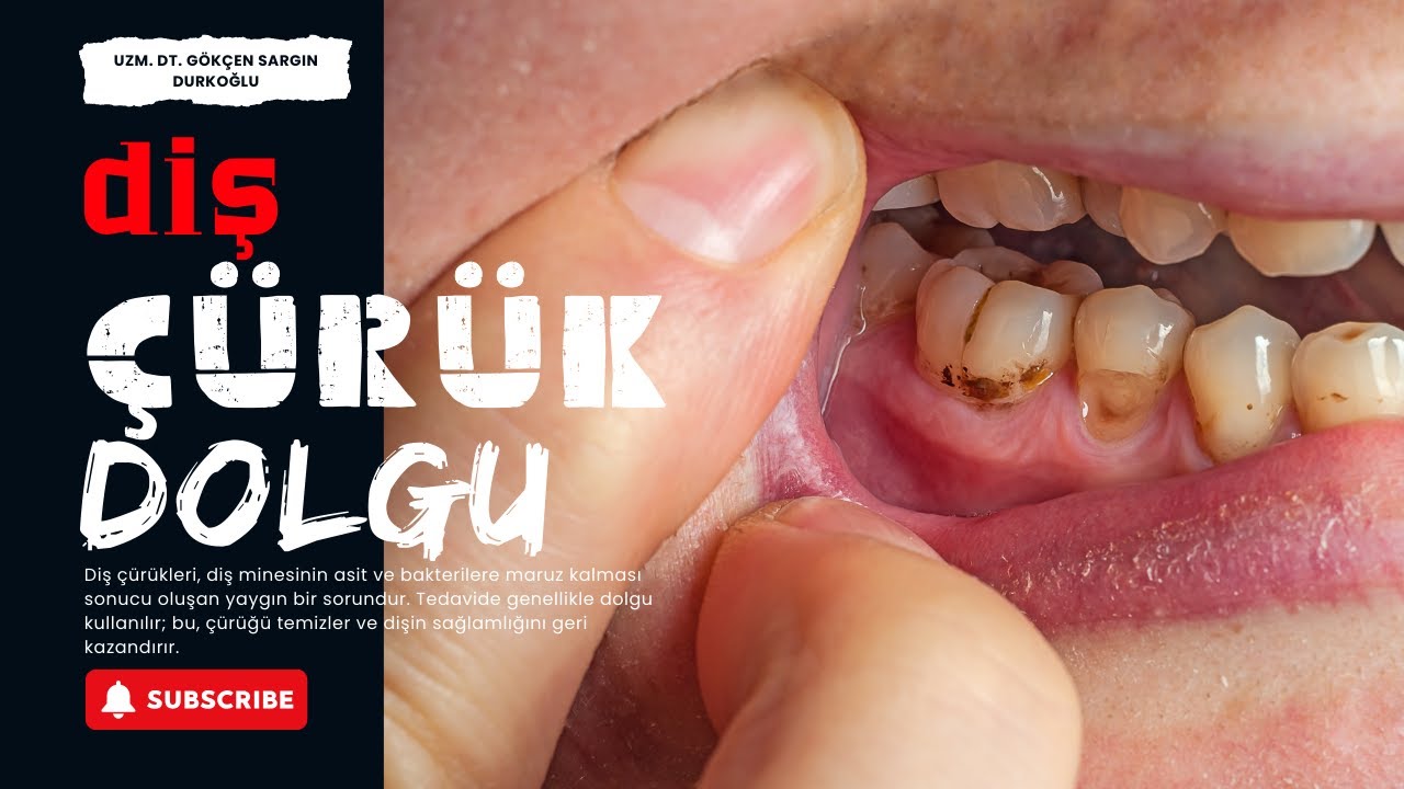 Diş Çürüğü Temizleme Ve Dolgu Nasıl Yapılır?