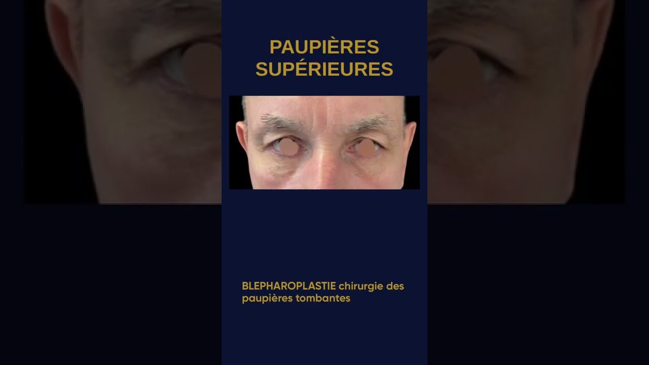 Avant après blépharoplastie supérieure