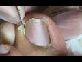 Professional ingrown nail treatment