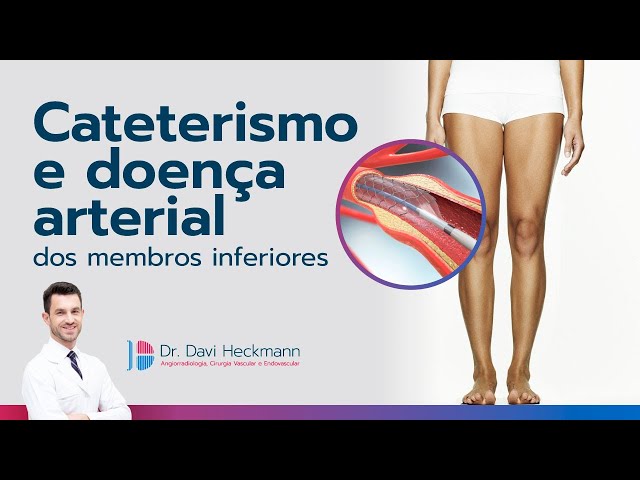 Cateterismo e doença arterial dos membros inferiores | Dr. Davi Heckmann