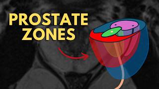 Prostate Zones Explained (Peripheral, Transition & Central) | Radiology Anatomy
