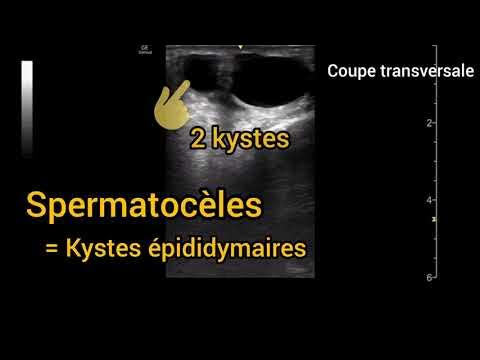 Kystes de l'Epididyme Spermatocèles Échographie