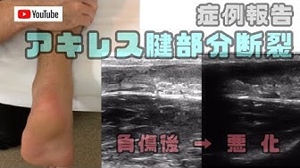アキレス腱断裂 Youtube