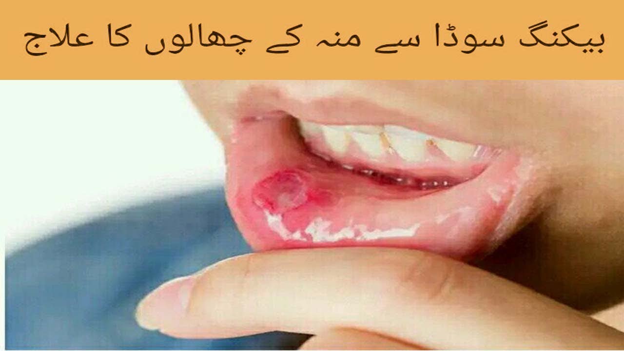 Mouth Kay Chalay Ka Ilaj Zuban Pe Chale Ka Ilaj Mu K Dano Ka Ilaj Mouth Blisters Treatment