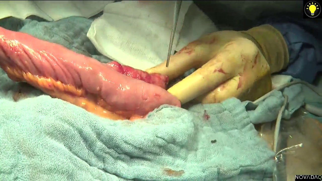 Laparoscopic restorative proctectomy with ileal JPouch in