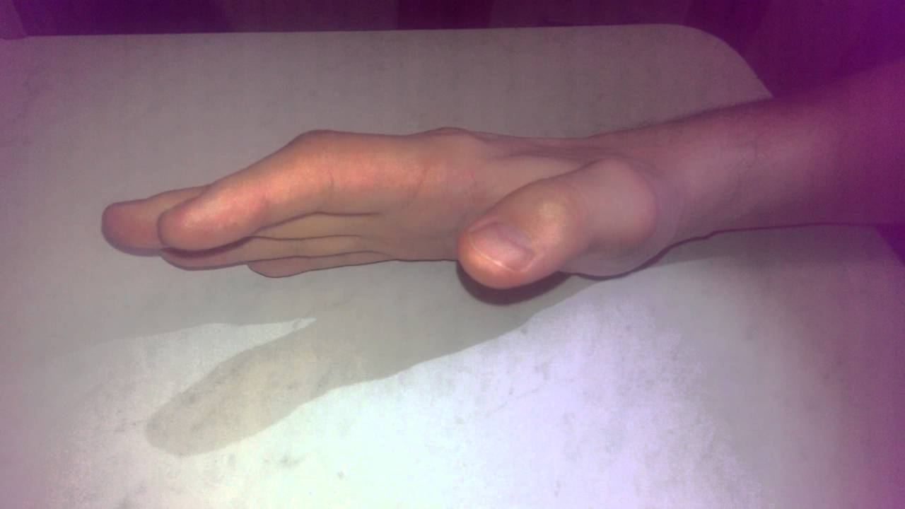 после операции по восстановлению сухожилий сгибателей 2го пальца кисти ...