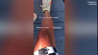 Ruby Rose shows her sunburn after spending the day outdoors